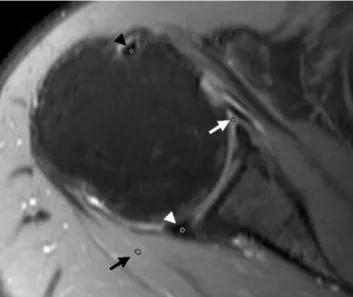 Table  1.  Comparison of SNR on Precontrast Fat-suppressed Proton-density Images, Contrast-enhanced Fat-suppressed Proton-density Images, and Contrast-enhanced Fat-suppressed T1 Weighted Images on Contrast-enhanced Shoulder MRI