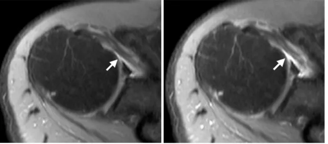 Table 2. Comparison of CNR between Synovium and Individual Articular Structures on Precontrast Fat-suppressed Proton-density Images, Contrast-enhanced Fat-suppressed Proton-density Images, and Contrast-enhanced Fat-suppressed T1 Weighted Images on Contrast