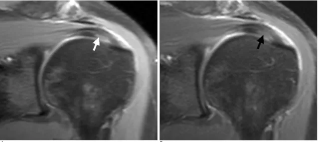 Fig. 4. A 53-year-old woman with partial-thickness articular surface tear of the supraspinatus tendon in the left shoulder