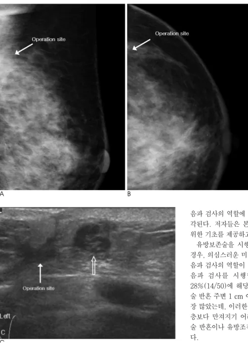 Fig. 2. A 45-year-old woman who un- un-derwent left side breast conserving surgery for invasive ductal carcinoma (T2N0M0) 10 months ago