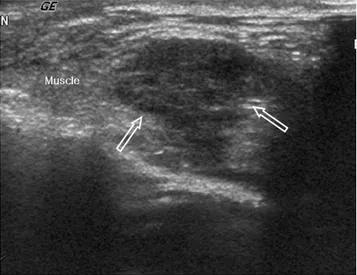 Fig. 3. A 61-year-old woman who underwent right side modi- modi-fied radical mastectomy for invasive ductal carcinoma (T2N0M0) about 8 years ago