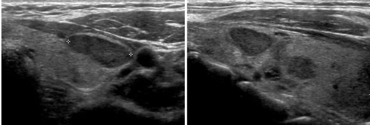 Fig. 4. Left thyroid gland shows well circumscribed, oval hypoechoic nodules. The nodule was confirmed to be an adenoma.
