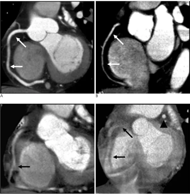 Fig. 1. Multiplanar reformations with a short axis view of the RCA in four patients, along with the semiquantitative four-point im- im-age quality scores