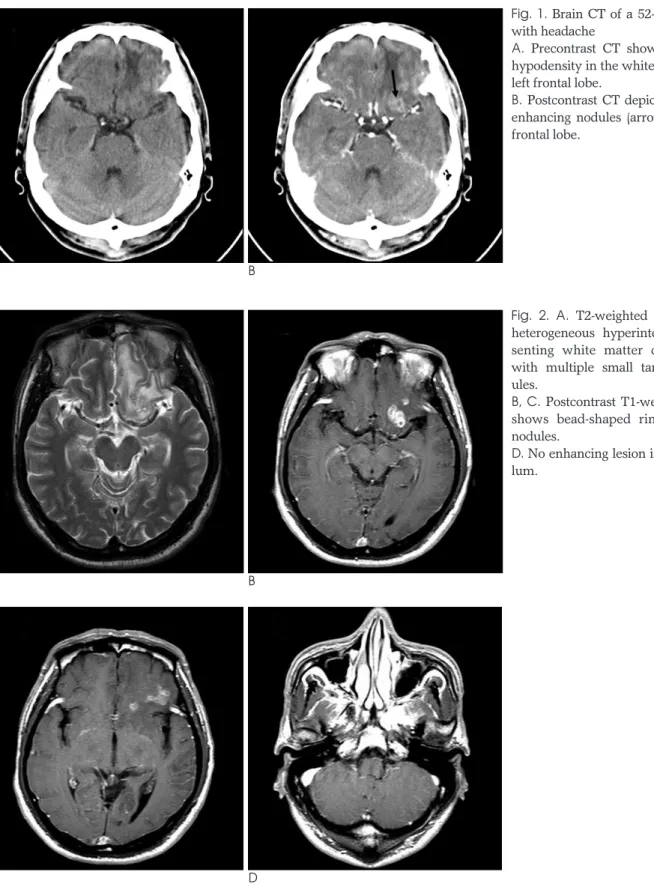 Fig. 1. Brain CT of a 52-year-old man with headache