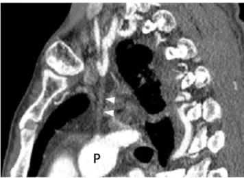Fig. 3. CT scan obtained 14 seconds later.
