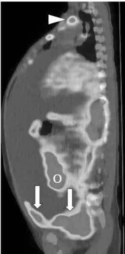 Fig.  4. Pathologic findings of small cell carcinoma in right ovary.