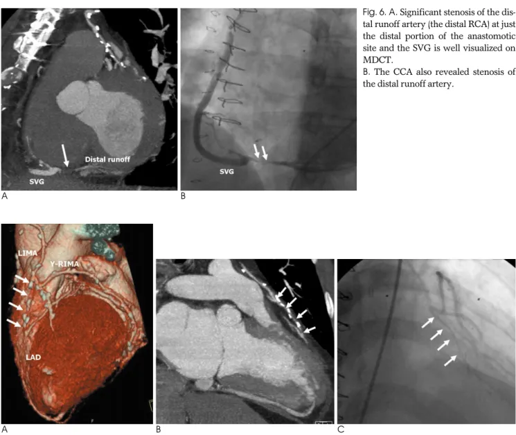 Fig. 6. A. Significant stenosis of the dis- dis-tal runoff artery (the disdis-tal RCA) at just the distal portion of the anastomotic site and the SVG is well visualized on MDCT