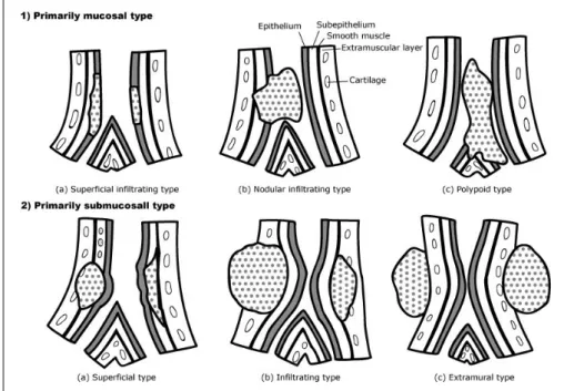 Fig.  1.  Classification of Bronchoscopic Findings (Revised classification by the Japan Lung Cancer Society) (11).