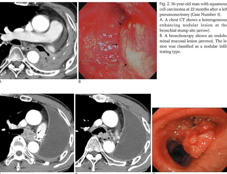 Fig. 2. 56-year-old man with squamous cell carcinoma at 22 months after a left pneumonectomy (Case Number 3)