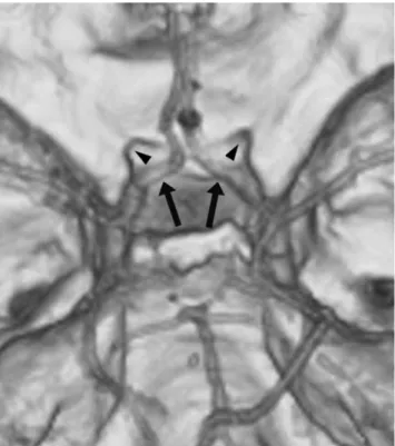 Fig. 1. A CT scan obtained at the level of the basal cistern in a 28-year-old woman shows diffuse subarachnoid hemorrhage