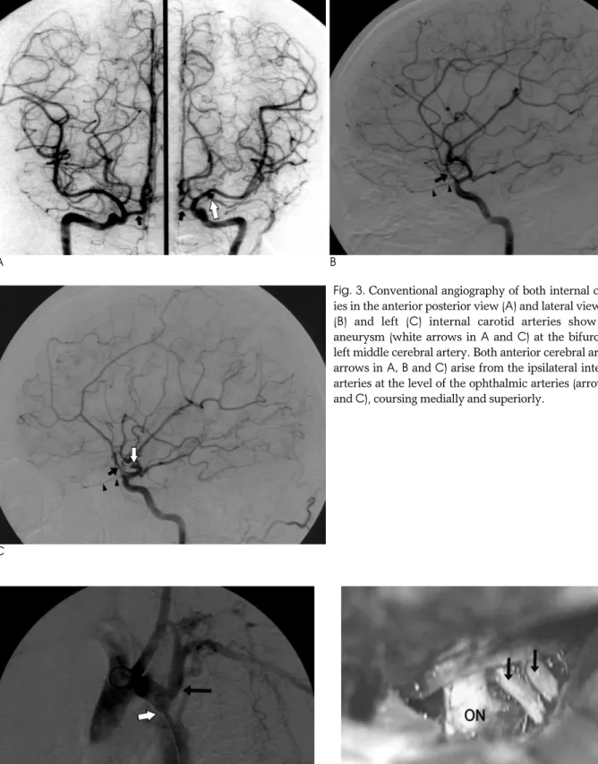 Fig. 3. Conventional angiography of both internal carotid arter- arter-ies in the anterior posterior view (A) and lateral view of the right (B) and left (C) internal carotid arteries show a saccular aneurysm (white arrows in A and C) at the bifurcation of 