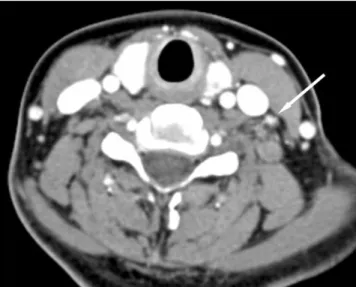 Fig. 1. A 38-year-old woman with papillary thyroid cancer in the left lobe of the thyroid gland