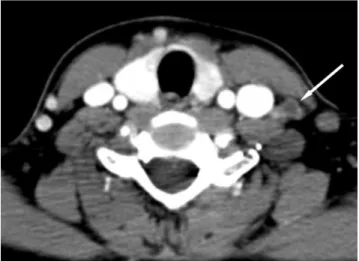 Fig. 3. A 55-year-old man with papillary thyroid cancer in the left lobe of the thyroid gland