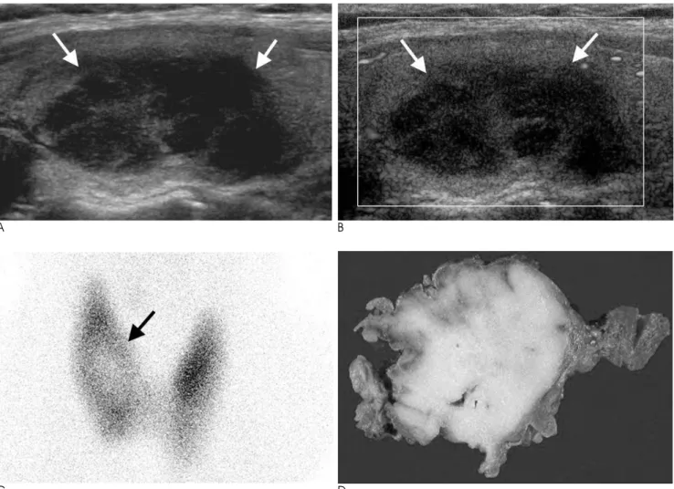 Fig. 2. Transverse sonogram of the right thyroid gland shows a partially ill defined pseudocystic septated hypoechoic mass (arrows, A)