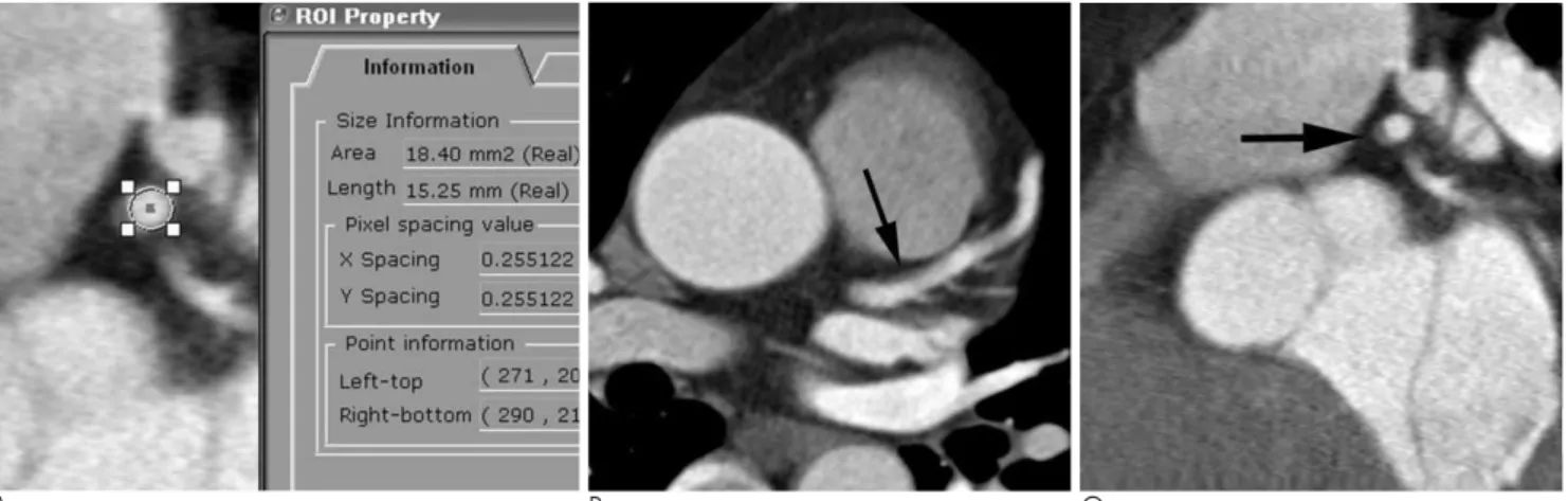 Fig. 1. A 47-year-old man with hypertension who underwent screening coronary CT angiography.