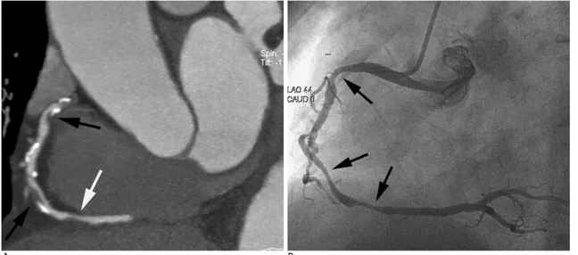 Fig. 2. A 69-year-old man with chest pain and family history of coronary artery disease.
