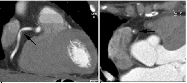Fig. 3. A 63-year-old woman with hypertension and diabetes mellitus who underwent coronary CT angiography for screening.