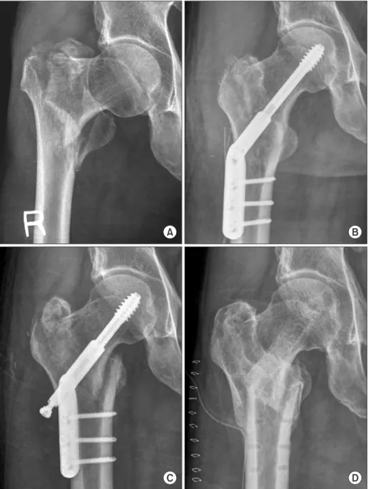 Figure 2. A 62-year-old man with inter- inter-trochanteric fracture fixed with  com-pression hip screw