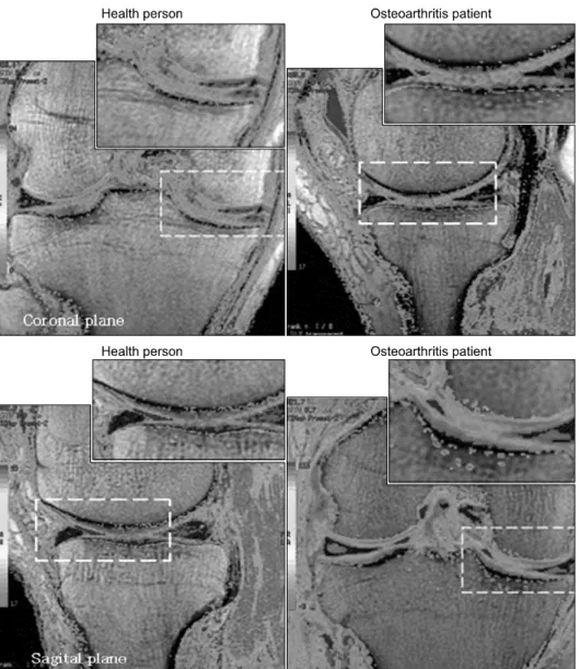 Fig.  5.  Color-coded  T2  maps.  Blind  tests  were  executed  by  two   radio-logists  and  three  practitioners  and  they  observed  sensory  changes  on  the  T2  map  color  scale  images.