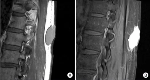Figure 1. A 52-year-old man with left  thigh mass (case 4). (A) Axial T1 weighted  image demonstrates a low to  inter-mediate SI tumor with cystic component  adjacent to the femoral vessel