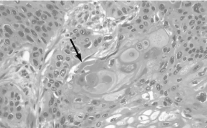 Fig. 6. Photomicrograph shows the feature of a well-differenti- well-differenti-ated squamous cell carcinoma