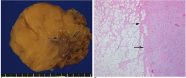 Fig. 1. F. The gross specimen showed a yellowish lipomatous tumor containing an eccentric nodular portion (black arrows) with a sharply defined border.