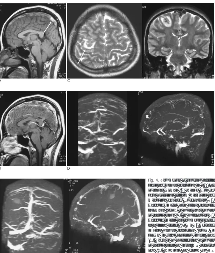 Fig. 4. Thrombosis of superior sagittal sinus and venous infarction in a 28-old pregnant woman (28 weeks) with  se-vere headache, left arm weakness, and mentality change