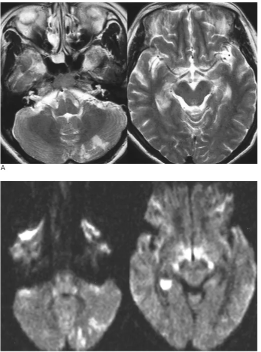 Fig. 7. Multifocal infarctions in a 35- 35-years-old woman who had a delivery one week ago at 38 weeks gestational period