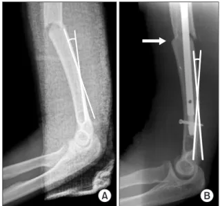 Figure 4. (A) Insertion of an intramedullary  nail should be done with caution when  site of fracture (imaginary dashed line)  is at the distal humeral shaft