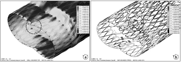 Fig.  8.  (a)  Distribution  of  Von  Mises  stress  in  the  biliary  stent  with  silicon,  and  (b)  without  silicon.