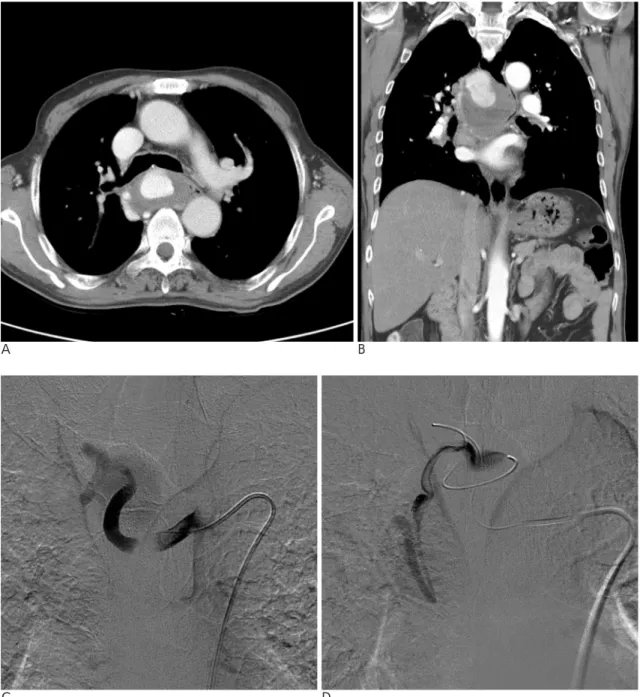 Fig. 1. A. Contrast-enhanced axial and (B) coronal CT images with mediastinal window setting show that enhancing subcarinal mass with contrast agent to the same degree as aorta