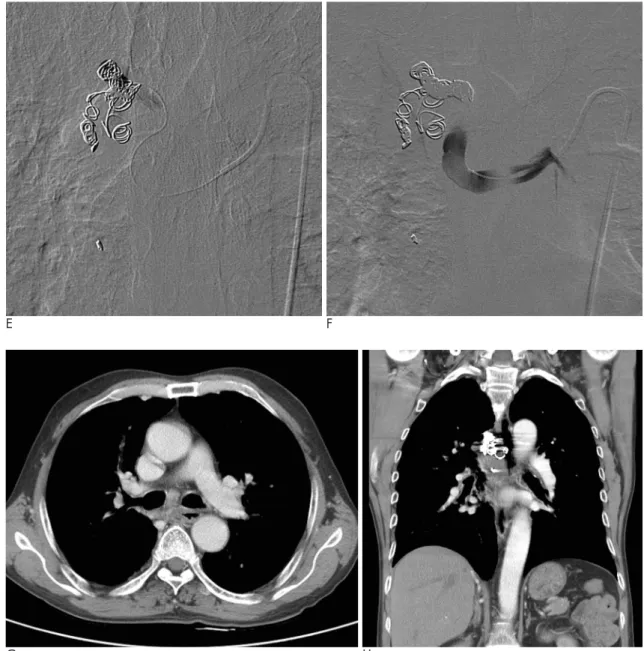 Fig. 1. E. Transcatheter bronchial artery coil embolization was performed in efferent artery at first and afferent artery at next