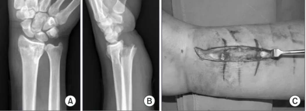 Figure 2. (A, B) Plain radiographs showing  a distal radius fracture with severe dorsal  displacement and a sharp anterior bony  spike