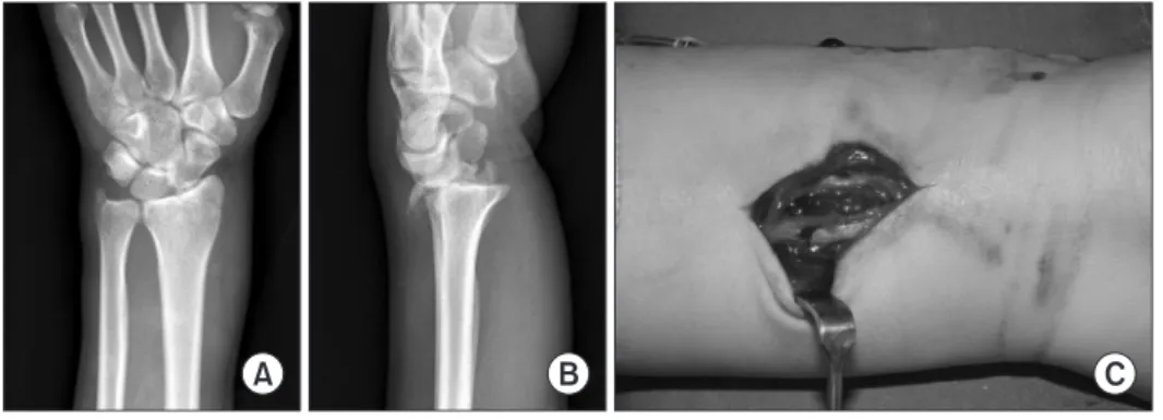 Figure 3. (A, B) Plain radiographs showing  a styloid fracture of the distal radius with  dorsal displacement and a sharp anterior  bony spike
