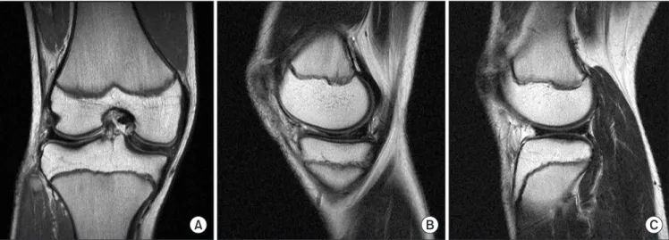 Figure 2. Arthroscopic views of the  right knee. The complete medial discoid  meniscus (A) and the incomplete lateral  discoid meniscus (B) are shown.
