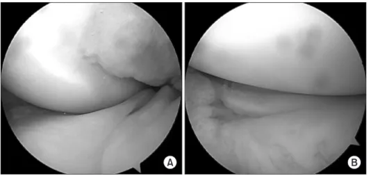 Figure 4. Arthroscopic views of the left knee. 