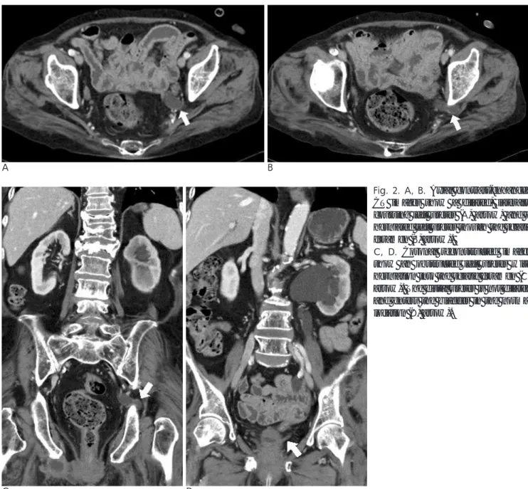 Fig. 2. A, B. Axial contrast-enhanced CT images show a dilated, laterally coursing left ureter (A, arrow) and a herniated left ureter though the sciatic foramen (B, arrow)