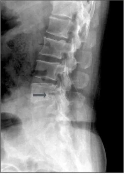 Figure 1. Preoperative plain radiograph shows a radiolucent lesion in  lumbar 4 vertebral body (arrow)