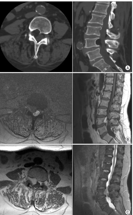 Figure 2. Computed tomography (CT)  scan and magnetic resonance imaging  show a well­defined fatty mass at lumbar  4 (L4) vertebral body with bony erosion