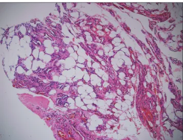 Figure 5. Microscopic photograph shows mature adipose tissue  interspersed with well vascularized areas, indicative of angiolipoma