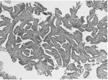 Fig. 2. Microphotograph of the tumor (H-E, ×100) illustrates multiple papillae in complex arborizing pattern with  well-de-veloped vascular connective tissue core surrounded by  epithe-lial and myoepitheepithe-lial cells.