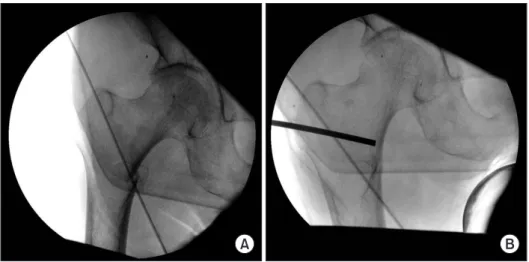 Figure 4. (A) Varus impaction of the  proximal fragment was noticed in stable  fracture pattern