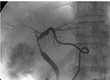 Fig. 5. Follow-up cholangiogram obtained 5 days after place- place-ment of the covered, self expandable, nitinol stent between the left hepatic duct and the common bile duct shows good  pa-tency of the stent with decompressed state of the intrahepatic bile