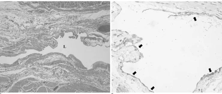 Fig. 1. E, F. The light microscopic examination reveals a large lymphatic channel (L) with flat endothelial cells (E) (H &amp; E stain, × 40) which are positive for D2-40 (F) (arrows) (× 200).