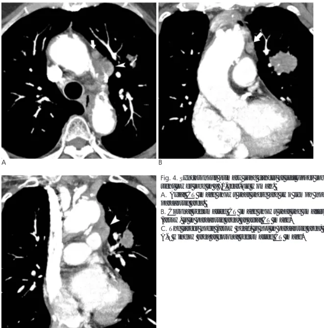 Fig. 4. Synchronous primary lung cancer at left upper lobe and right lower lobe in a 70-year-old woman