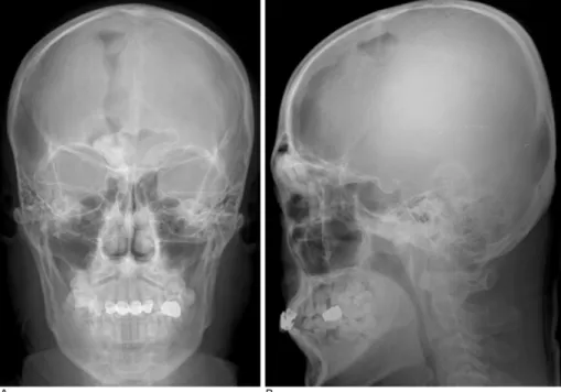 Fig. 3. Right parasagittal view of sagittal reconstructed com- com-puted tomography image demonstrates well defined ossifying mass in right frontoethmoid sinus invading to right frontal lobe and well defined pneumocephalus in right frontal lobe.