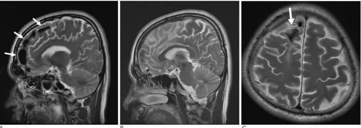 Fig. 4. MRI taken on attack of sudden left side weakness (6 year after the initial MRI)