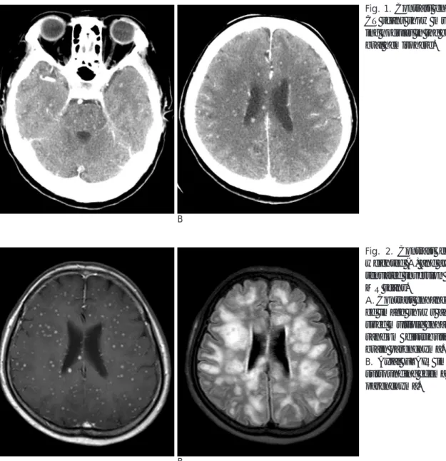 Fig. 1. Contrast enhanced axial brain CT scans show multiple tiny  enhanc-ing nodules in the brain stem and  cere-bral hemisphere.