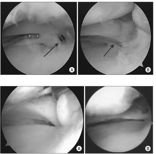 Figure 2. (A) Pullout suture for degene- degene-rative rupture of the medial meniscus  posterior root (arrow)