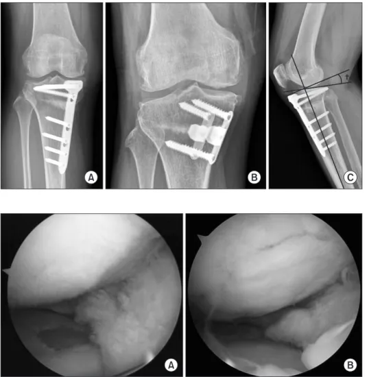 Figure 2. Long locking plate (A) and short  spacer plate (B) were used for high  ti-bial osteotomy